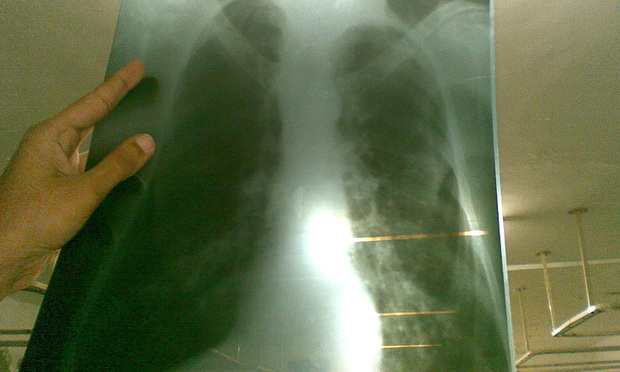 Lung-X-Ray - Phoenix119 via Wikimedia Commons